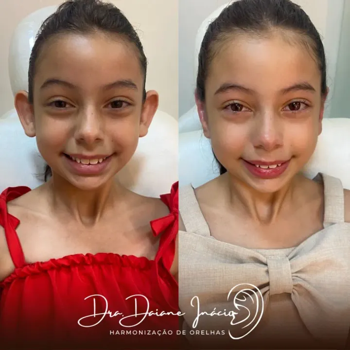 Antes e depois de correção de orelha de abano em menina
