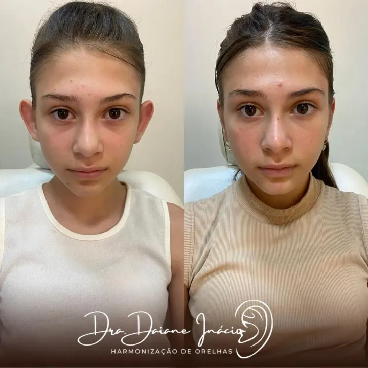 Antes e depois de harmonização de orelhas em adolescente