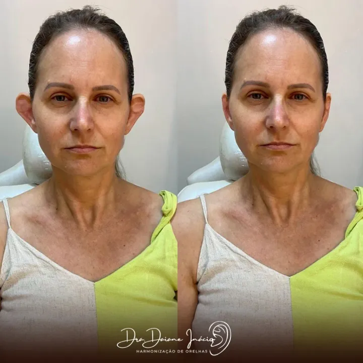 Antes e depois de harmonização de orelhas em adulta, Dra. Daiane Inácio
