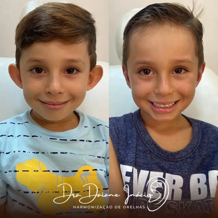 Antes e depois de harmonização de orelhas em criança, Francisco Beltrão