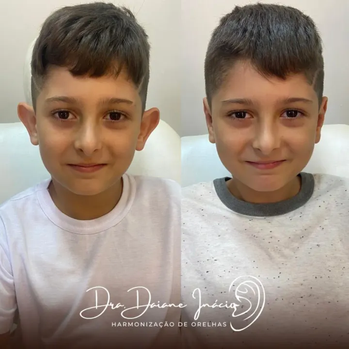 Antes e depois de orelha de abano corrigida sem cirurgia em menino
