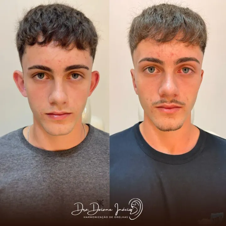 Antes e depois de harmonização de orelhas em rapaz