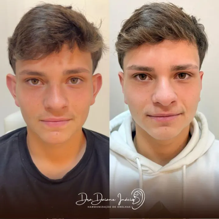 Antes e depois de otoplastia sem cortes em adolescente