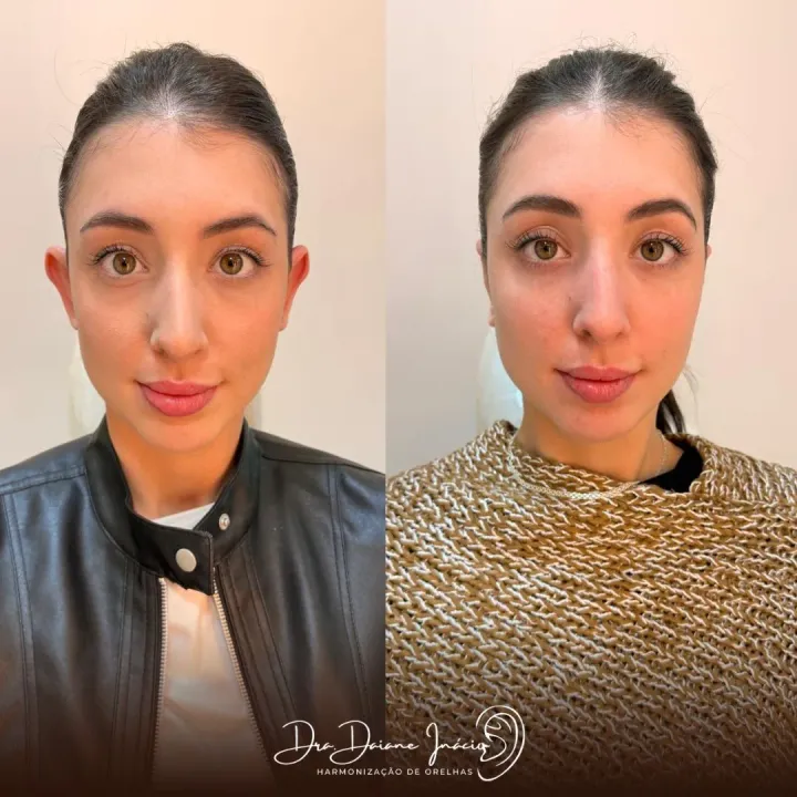 Antes e depois de harmonização de orelhas em mulher adulta