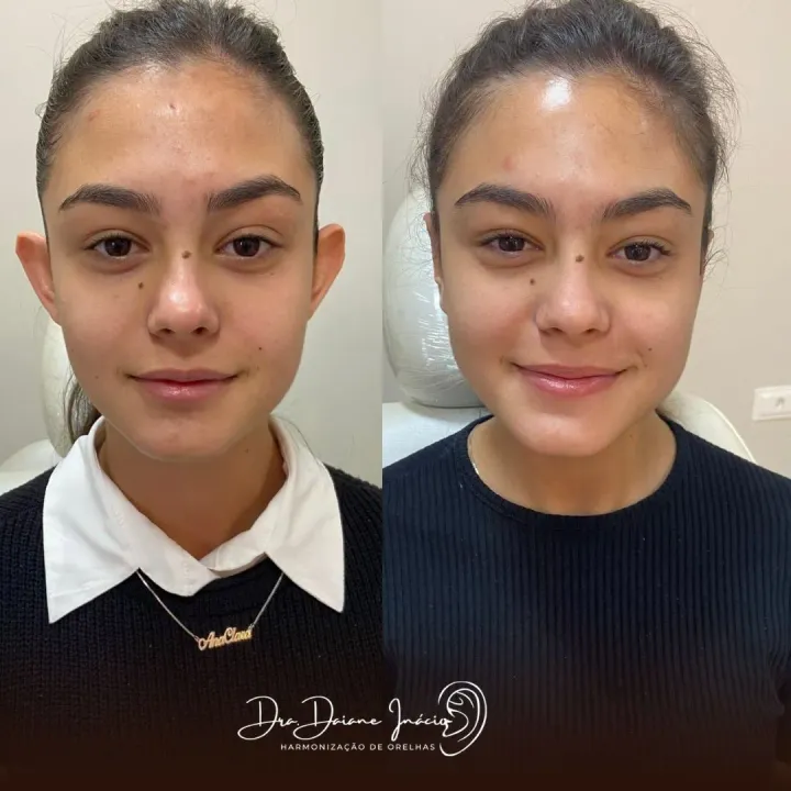 Antes e depois de correção de orelha de abano em jovem